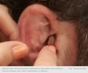 demenz